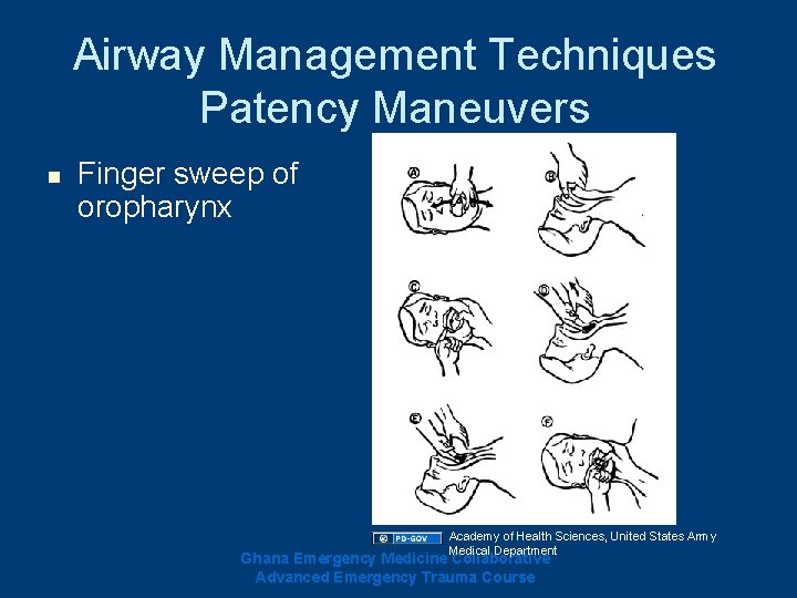 Airway Management Techniques Patency Maneuvers n Finger sweep of oropharynx Academy of Health Sciences, Airway Management Techniques Patency Maneuvers n Finger sweep of oropharynx Academy of Health Sciences,