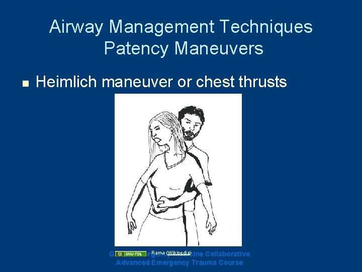 Airway Management Techniques Patency Maneuvers n Heimlich maneuver or chest thrusts Rama (Wikipedia) Ghana Airway Management Techniques Patency Maneuvers n Heimlich maneuver or chest thrusts Rama (Wikipedia) Ghana