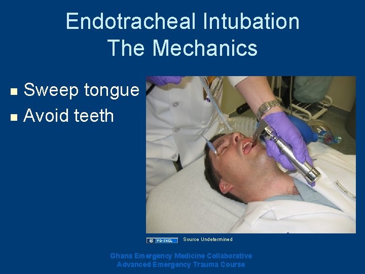 Endotracheal Intubation The Mechanics Sweep tongue n Avoid teeth n Source Undetermined Ghana Emergency Endotracheal Intubation The Mechanics Sweep tongue n Avoid teeth n Source Undetermined Ghana Emergency