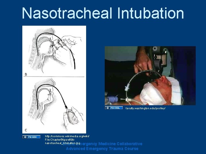 Nasotracheal Intubation faculty. washington. edu/pcolley/ http: //commons. wikimedia. org/wiki/ File: Chapter 5 figure 69 Nasotracheal Intubation faculty. washington. edu/pcolley/ http: //commons. wikimedia. org/wiki/ File: Chapter 5 figure 69