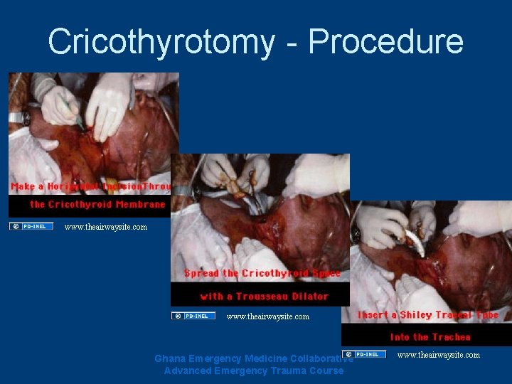 Cricothyrotomy - Procedure www. theairwaysite. com Ghana Emergency Medicine Collaborative Advanced Emergency Trauma Course Cricothyrotomy - Procedure www. theairwaysite. com Ghana Emergency Medicine Collaborative Advanced Emergency Trauma Course