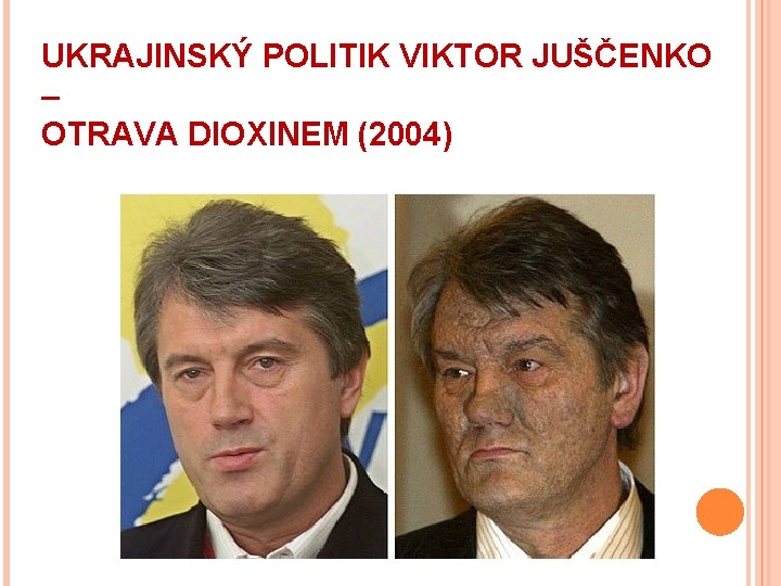 UKRAJINSKÝ POLITIK VIKTOR JUŠČENKO – OTRAVA DIOXINEM (2004) 