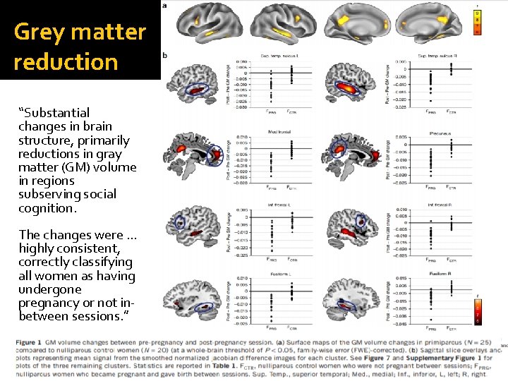 Grey matter reduction “Substantial changes in brain structure, primarily reductions in gray matter (GM) Grey matter reduction “Substantial changes in brain structure, primarily reductions in gray matter (GM)