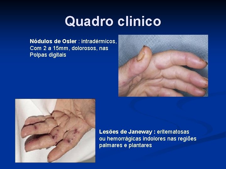 Quadro clinico Nódulos de Osler : intradérmicos, Com 2 a 15 mm, dolorosos, nas
