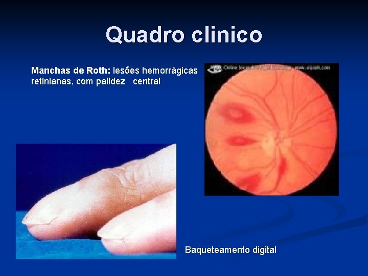 Quadro clinico Manchas de Roth: lesões hemorrágicas retinianas, com palidez central Baqueteamento digital 