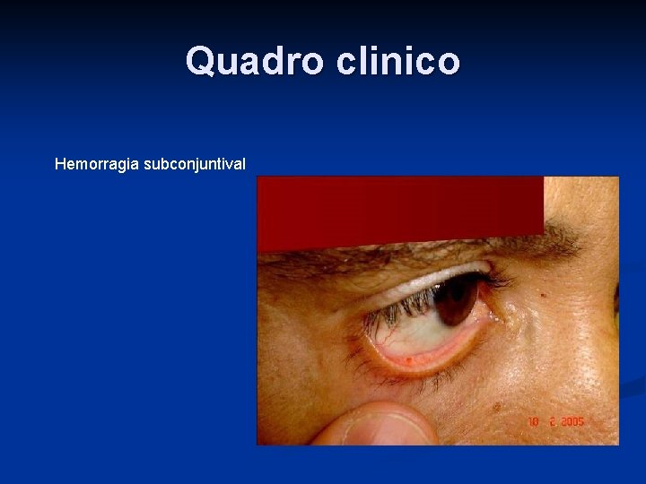 Quadro clinico Hemorragia subconjuntival 
