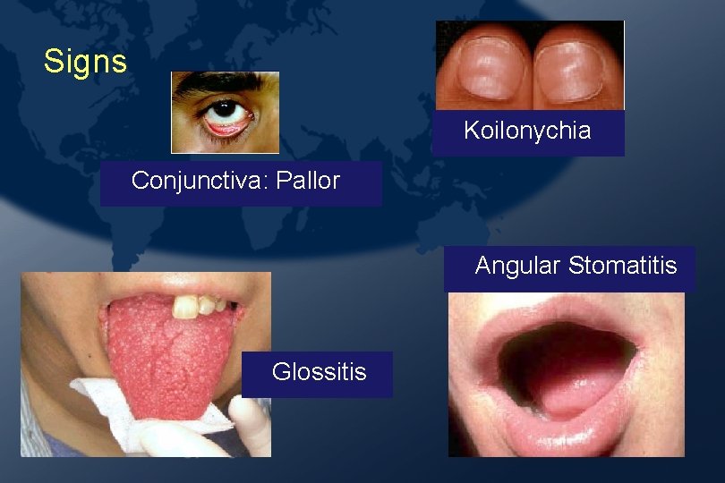 Signs Koilonychia Conjunctiva: Pallor Angular Stomatitis Glossitis Signs Koilonychia Conjunctiva: Pallor Angular Stomatitis Glossitis