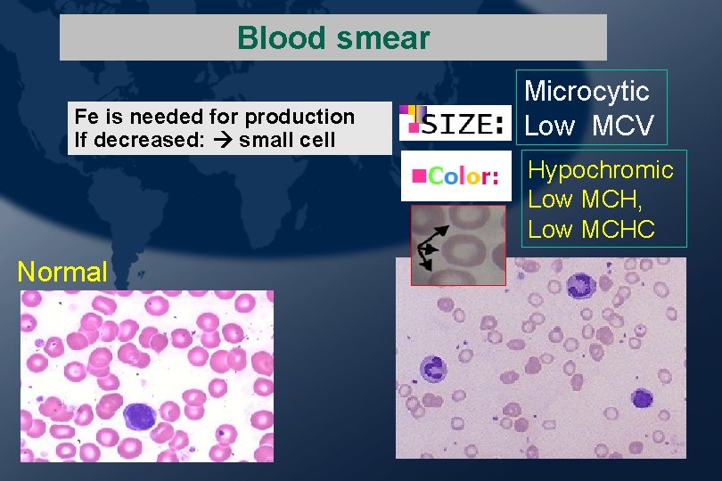 Blood smear Fe is needed for production If decreased: small cell Microcytic Low MCV Blood smear Fe is needed for production If decreased: small cell Microcytic Low MCV