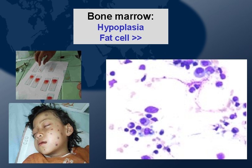 Bone marrow: Hypoplasia Fat cell >> Bone marrow: Hypoplasia Fat cell >>