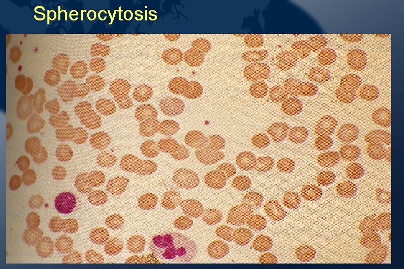 Spherocytosis Spherocytosis