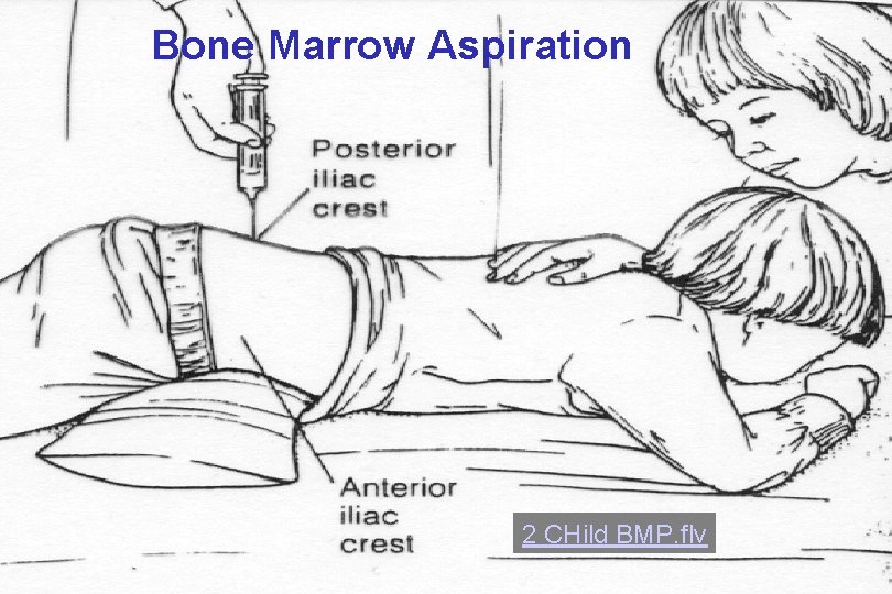 Bone Marrow Aspiration 2 CHild BMP. flv Bone Marrow Aspiration 2 CHild BMP. flv