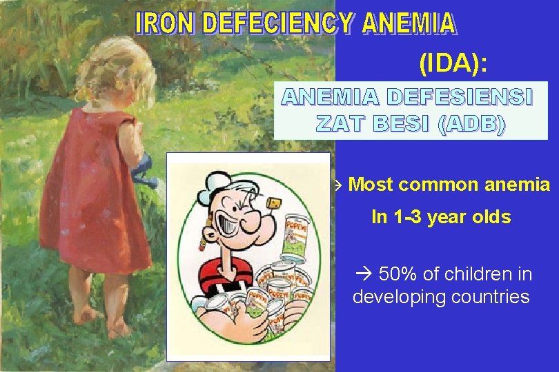 (IDA): ANEMIA DEFESIENSI ZAT BESI (ADB) Most common anemia In 1 -3 year olds (IDA): ANEMIA DEFESIENSI ZAT BESI (ADB) Most common anemia In 1 -3 year olds