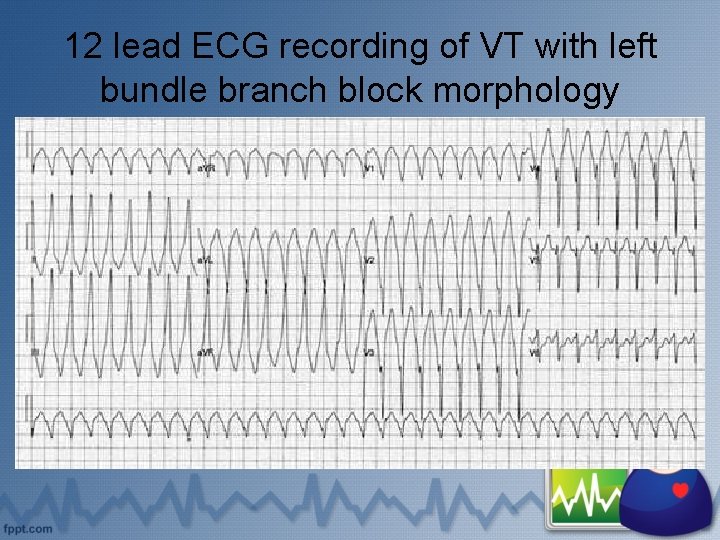 12 lead ECG recording of VT with left bundle branch block morphology 