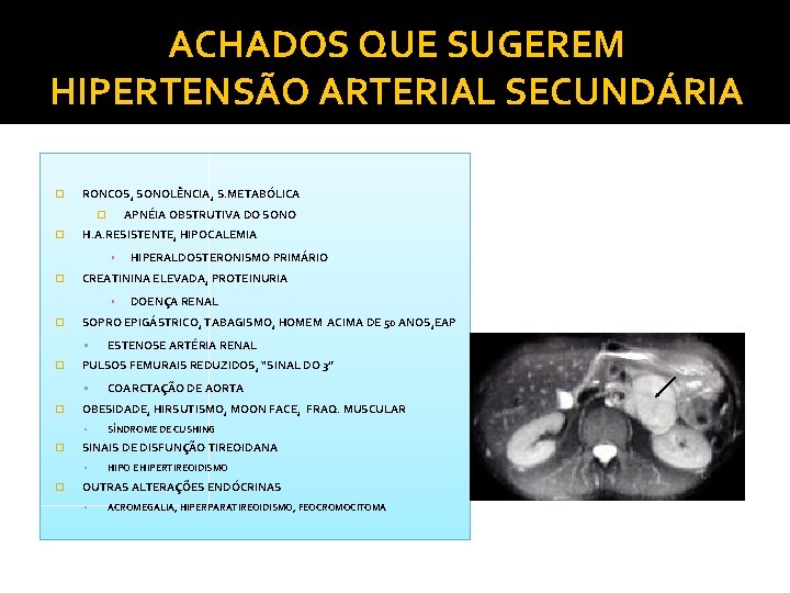 ACHADOS QUE SUGEREM HIPERTENSÃO ARTERIAL SECUNDÁRIA � RONCOS, SONOLÊNCIA, S. METABÓLICA APNÉIA OBSTRUTIVA DO ACHADOS QUE SUGEREM HIPERTENSÃO ARTERIAL SECUNDÁRIA � RONCOS, SONOLÊNCIA, S. METABÓLICA APNÉIA OBSTRUTIVA DO