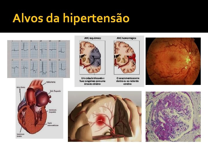 Alvos da hipertensão Alvos da hipertensão