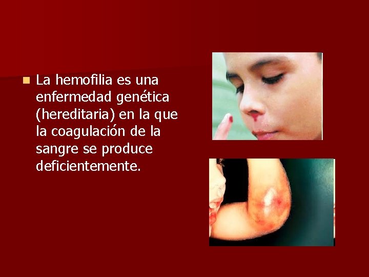 n La hemofilia es una enfermedad genética (hereditaria) en la que la coagulación de