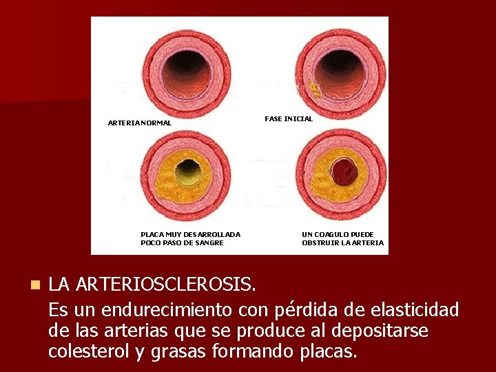 ARTERIA NORMAL PLACA MUY DESARROLLADA POCO PASO DE SANGRE n FASE INICIAL UN COAGULO