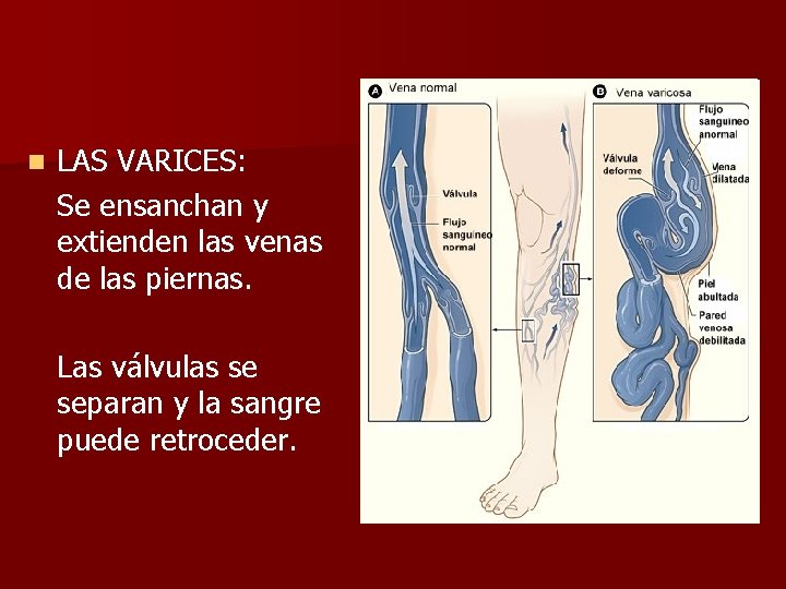 n LAS VARICES: Se ensanchan y extienden las venas de las piernas. Las válvulas