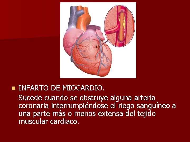 n INFARTO DE MIOCARDIO. Sucede cuando se obstruye alguna arteria coronaria interrumpiéndose el riego