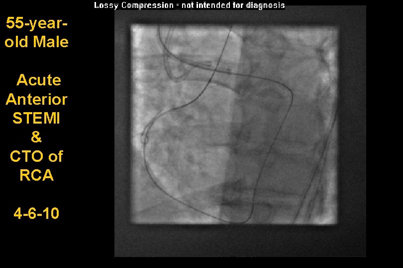 55 -yearold Male Acute Anterior STEMI & CTO of RCA 4 -6 -10 