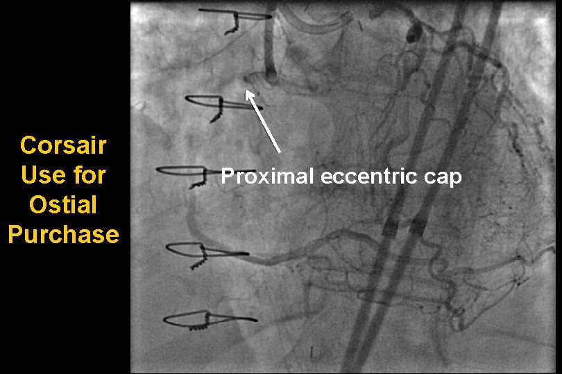 Corsair Use for Ostial Purchase Proximal eccentric cap 