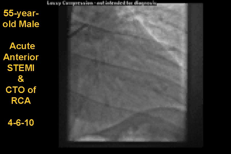 55 -yearold Male Acute Anterior STEMI & CTO of RCA 4 -6 -10 
