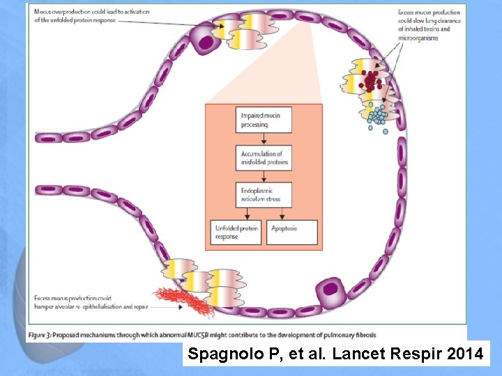 Spagnolo P, et al. Lancet Respir 2014 