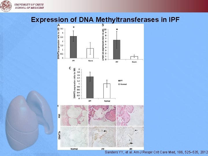 UNIVERSITY OF CRETE SCHOOL OF MEDICINE Expression of DNA Methyltransferases in IPF Sanders YY,