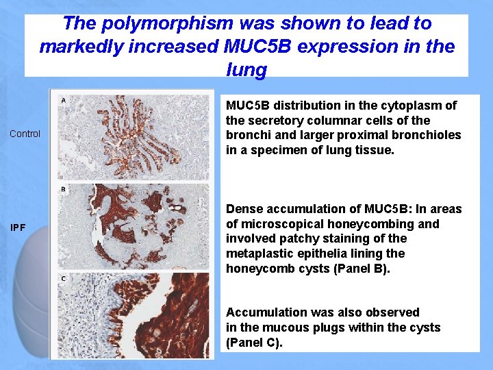 The polymorphism was shown to lead to markedly increased MUC 5 B expression in