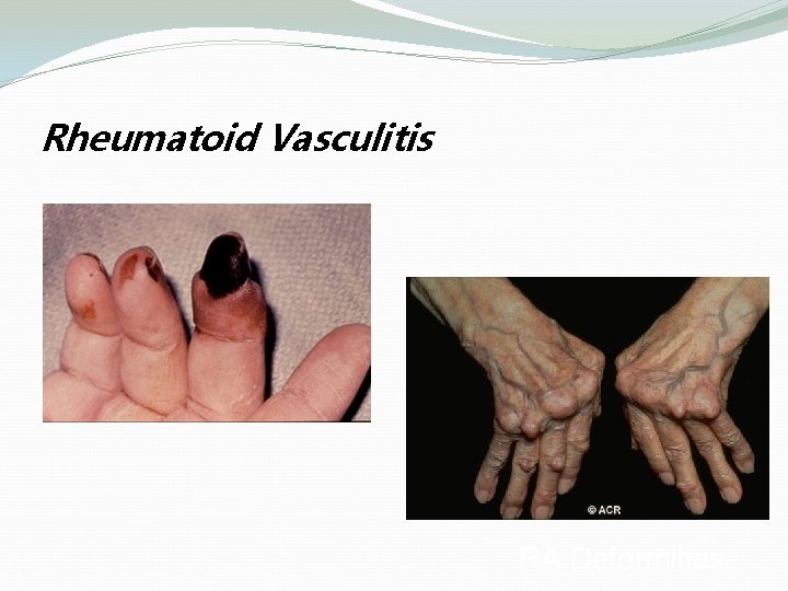 Rheumatoid Vasculitis RA Deformities 