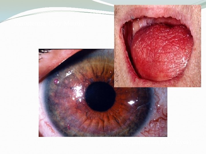 Xerostomia (Dry Mouth) Xerophthalmia (Dry Eyes) 