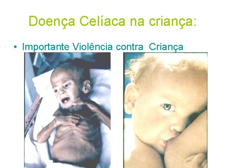 Doença Celíaca na criança: • Importante Violência contra Criança Doença Celíaca na criança: • Importante Violência contra Criança
