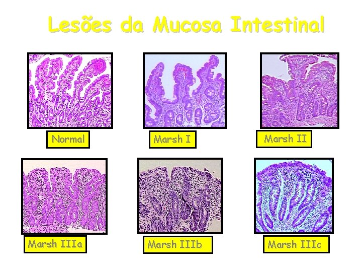 Lesões da Mucosa Intestinal Normal Marsh IIIa Marsh IIIb Marsh IIIc Lesões da Mucosa Intestinal Normal Marsh IIIa Marsh IIIb Marsh IIIc