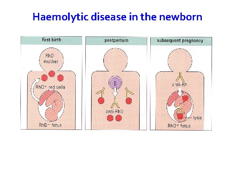 Haemolytic disease in the newborn 46 Rh. D- mother with Rh. D+ fetus can