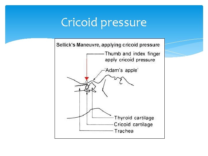 Cricoid pressure 
