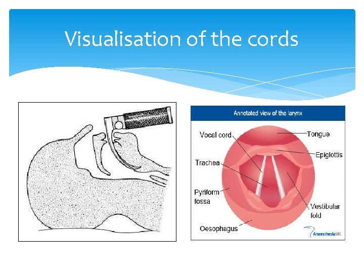 Visualisation of the cords 