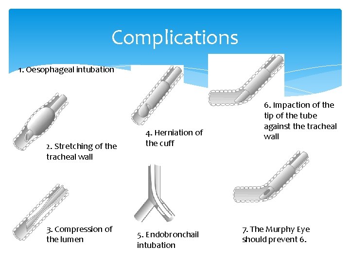 Complications 1. Oesophageal intubation 2. Stretching of the tracheal wall 3. Compression of the
