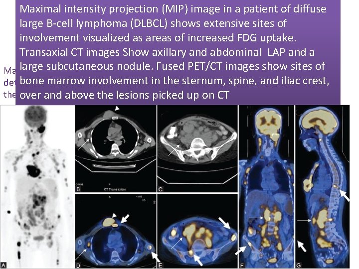 Maximal intensity projection (MIP) image in a patient of diffuse large B-cell lymphoma (DLBCL)