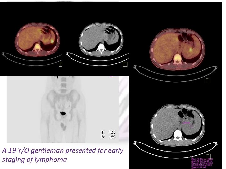 A 19 Y/O gentleman presented for early staging of lymphoma 