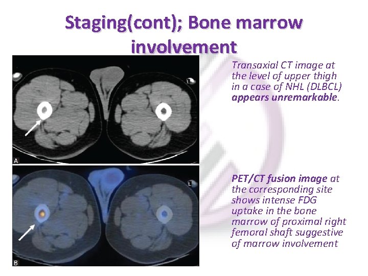 Staging(cont); Bone marrow involvement Transaxial CT image at the level of upper thigh in