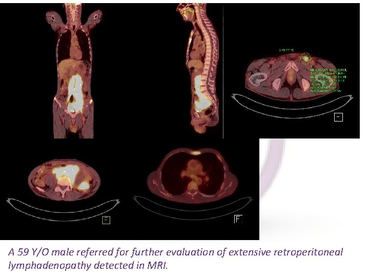 A 59 Y/O male referred for further evaluation of extensive retroperitoneal lymphadenopathy detected in