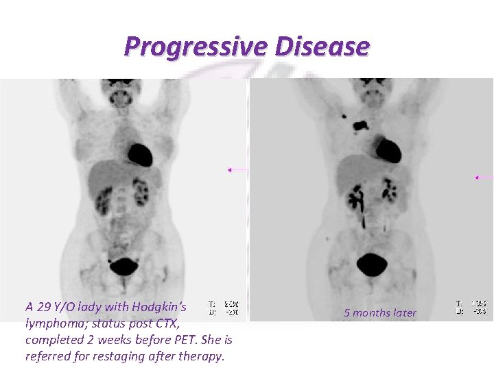Progressive Disease A 29 Y/O lady with Hodgkin’s lymphoma; status post CTX, completed 2