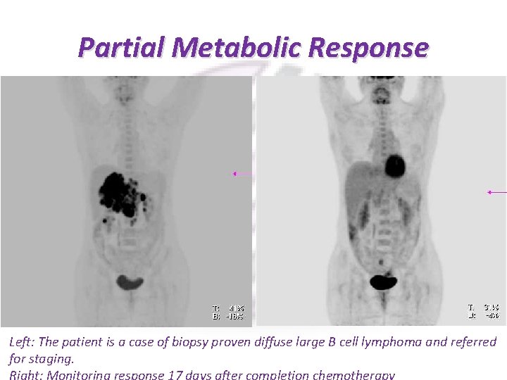 Partial Metabolic Response Left: The patient is a case of biopsy proven diffuse large