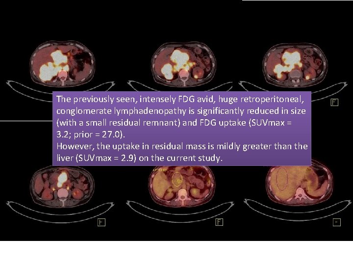 The previously seen, intensely FDG avid, huge retroperitoneal, conglomerate lymphadenopathy is significantly reduced in