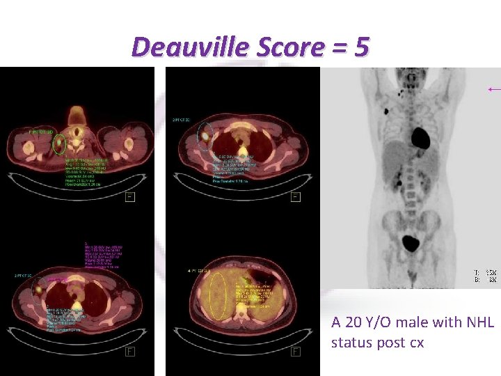 Deauville Score = 5 A 20 Y/O male with NHL status post cx 