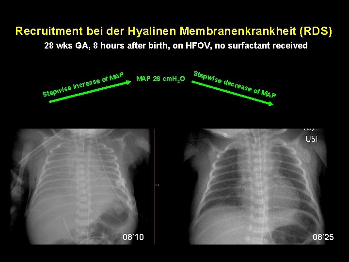 Recruitment bei der Hyalinen Membranenkrankheit (RDS) 28 wks GA, 8 hours after birth, on