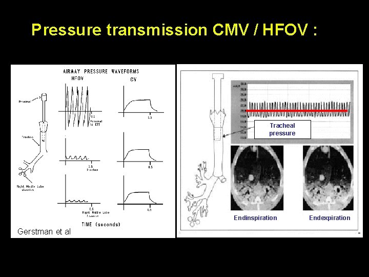 Pressure transmission CMV / HFOV : Tracheal pressure Endinspiration Gerstman et al Endexpiration 