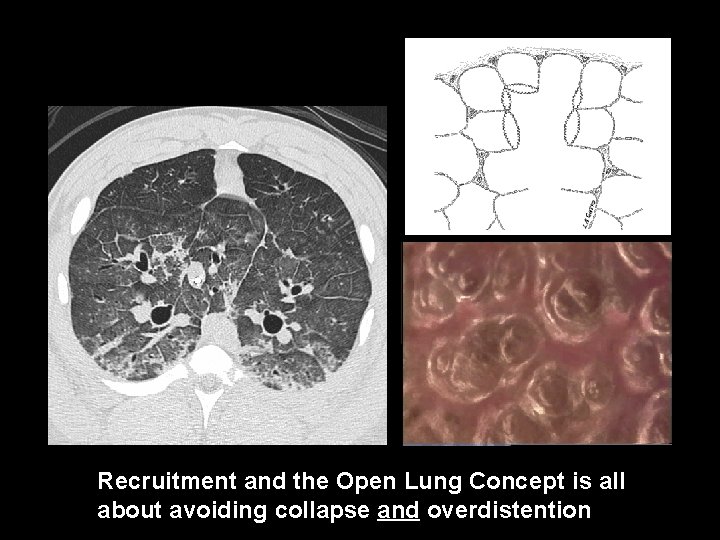 Recruitment and the Open Lung Concept is all about avoiding collapse and overdistention 