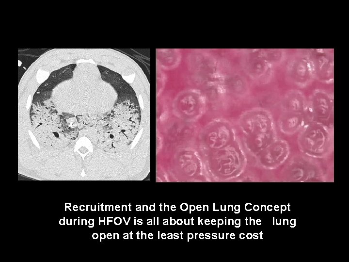 Recruitment and the Open Lung Concept during HFOV is all about keeping the lung