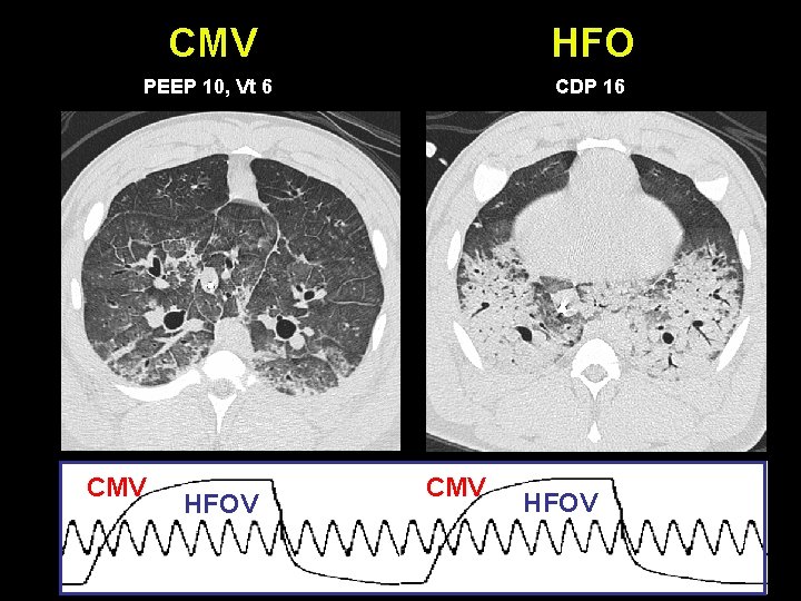 CMV HFO PEEP 10, Vt 6 CDP 16 CMV HFOV 